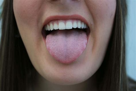 língua branca fígado
